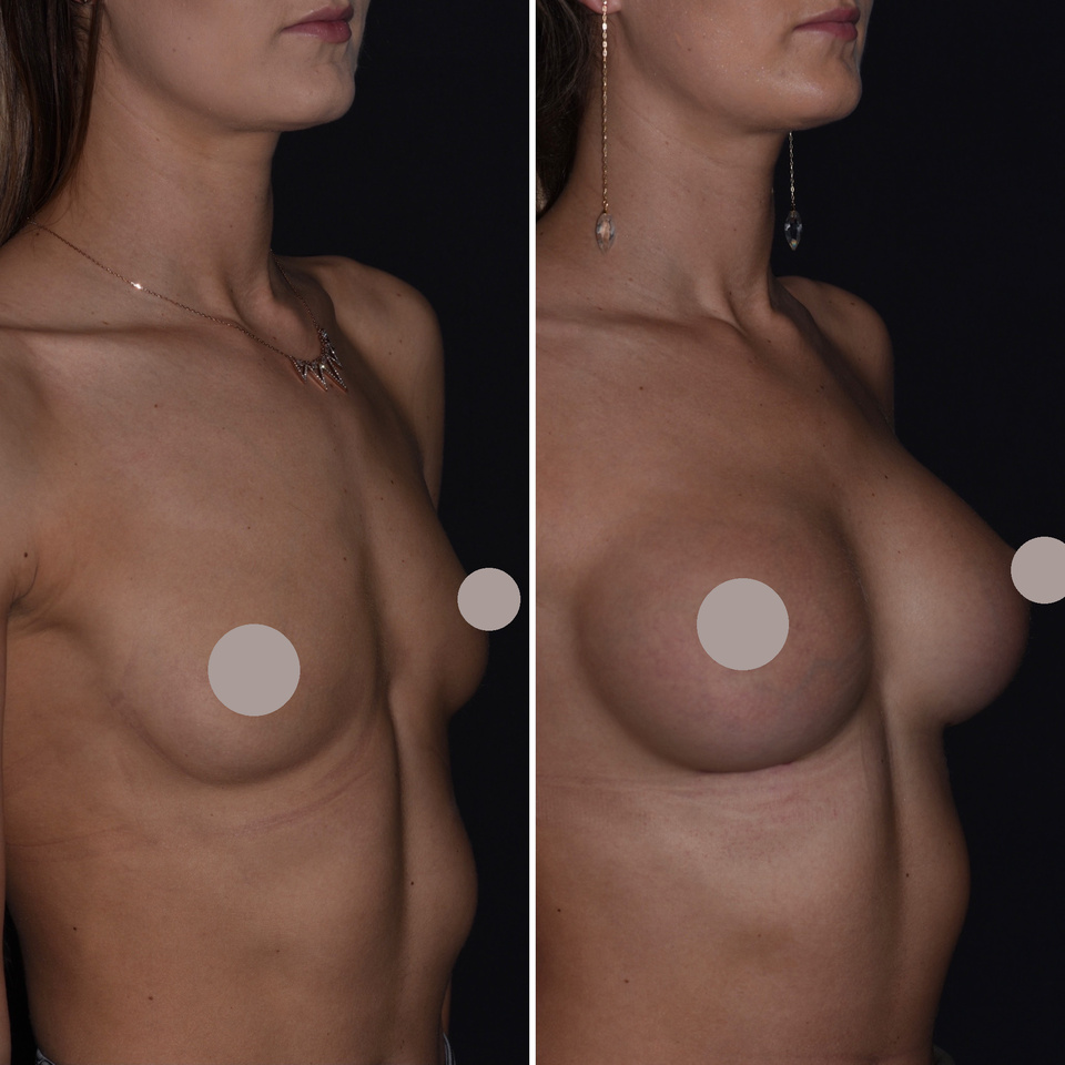 Photographies de chirurgie mammaire avec zones intimes masquées