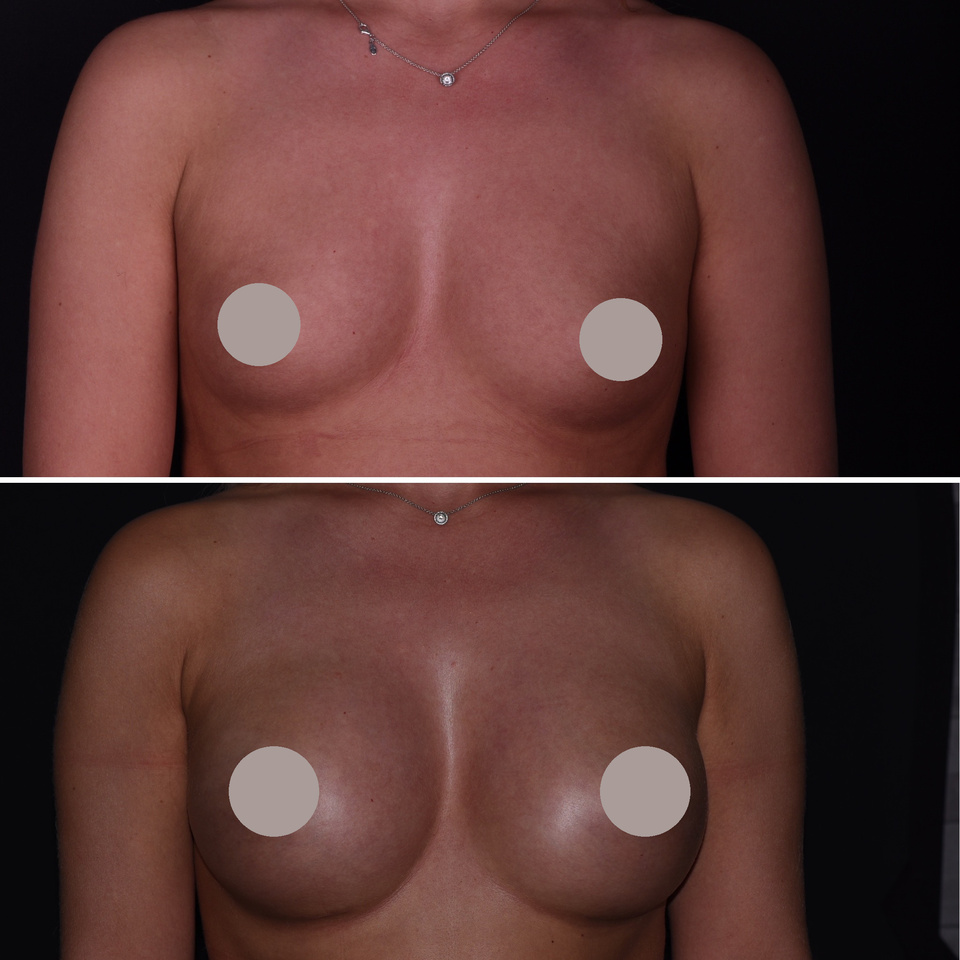 Augmentation mammaire — Comparaison 2