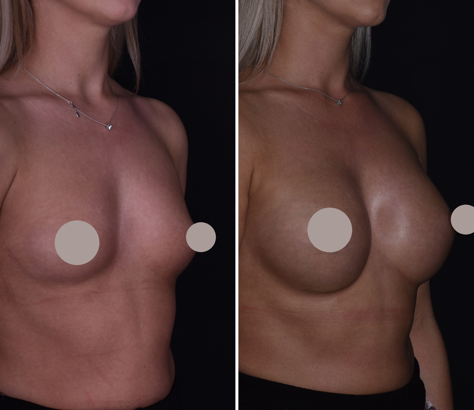 Augmentation mammaire — Comparaison 3