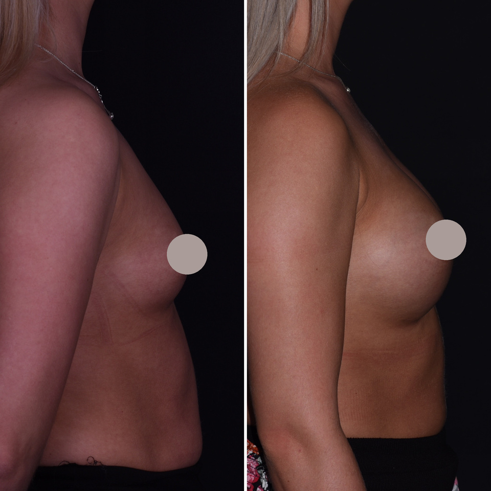 Augmentation mammaire — Comparaison 6
