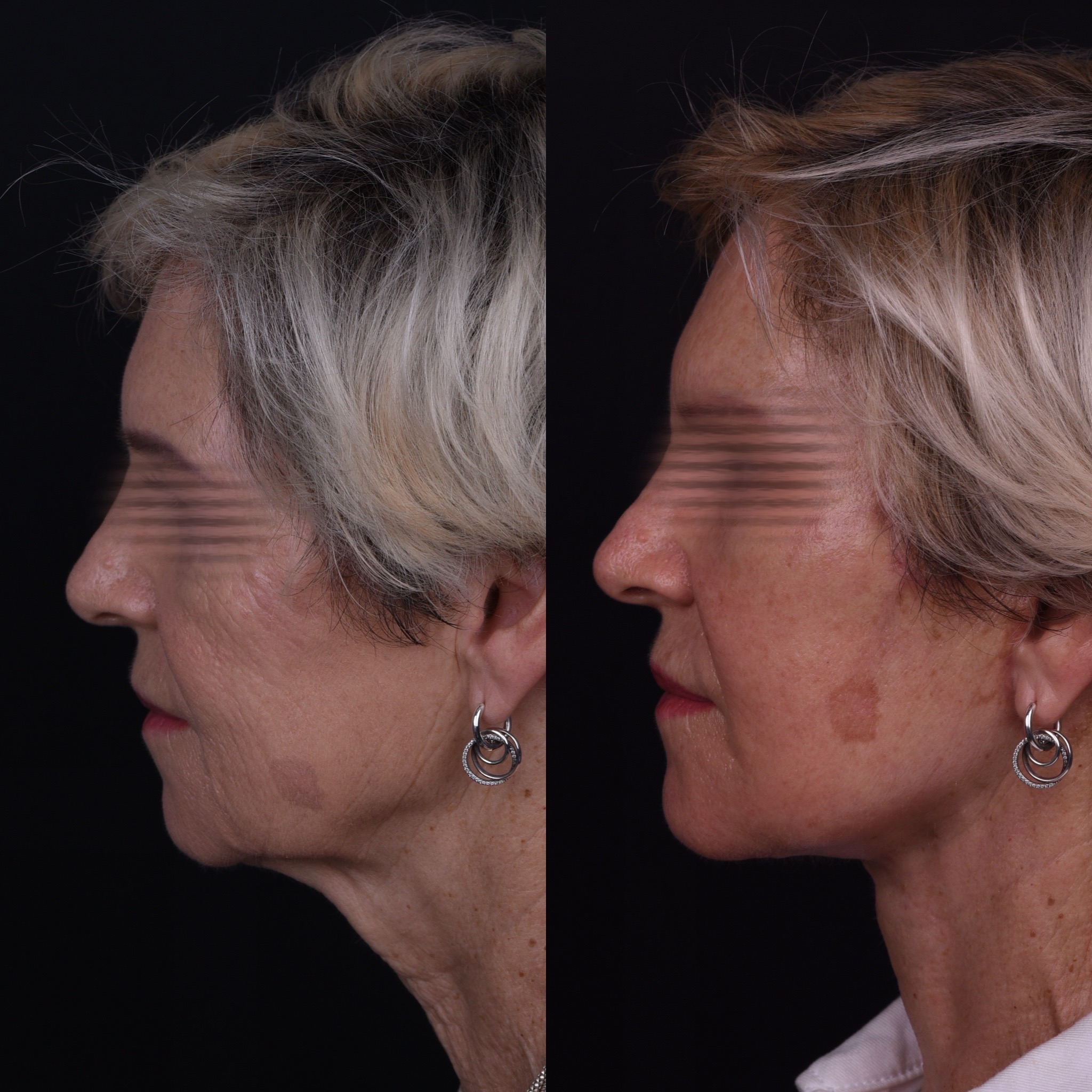 Photographies avant-après de lifting du visage et du cou