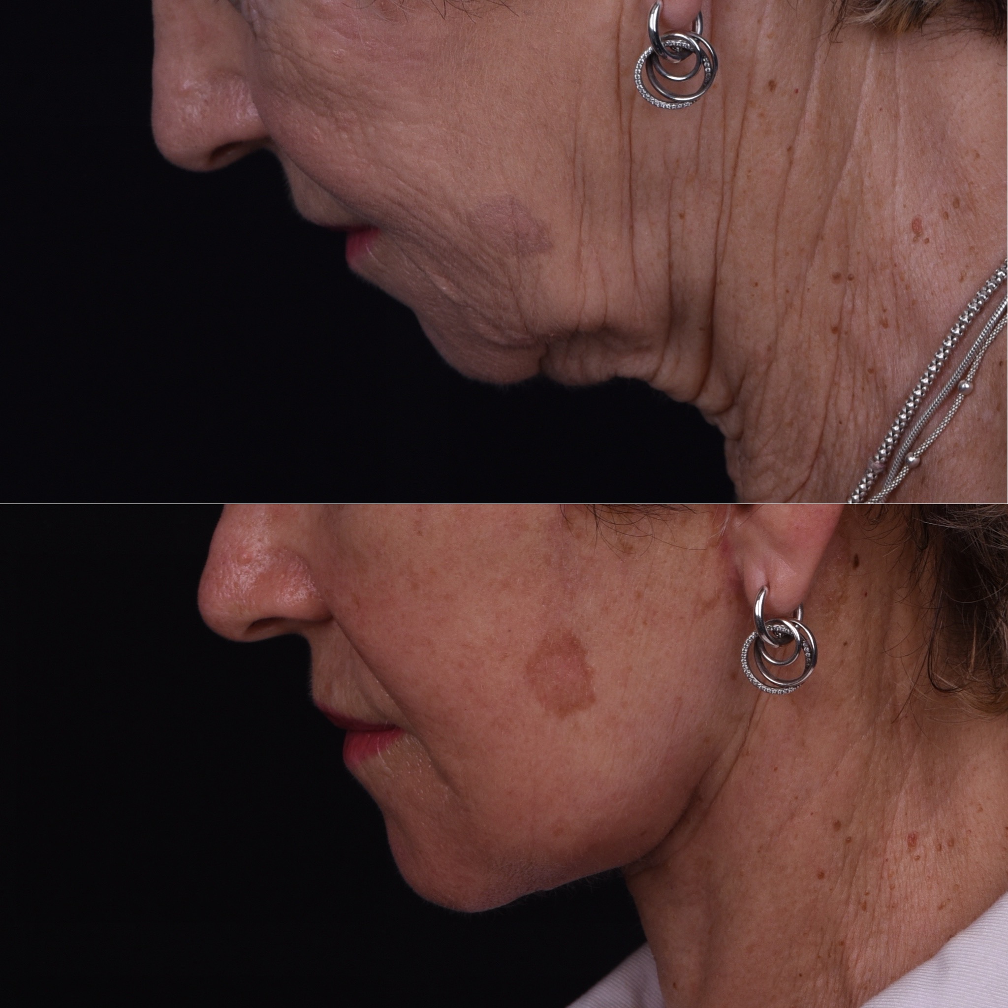 Lifting du visage et du cou — Comparaison 2