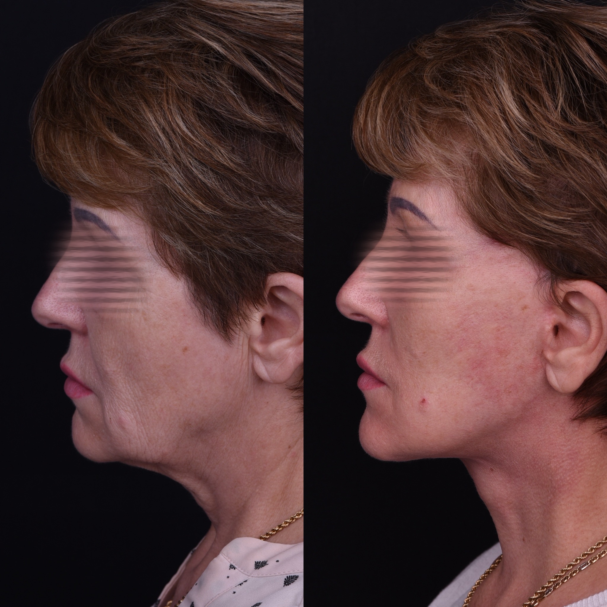 Lifting du visage et du cou — Comparaison 3