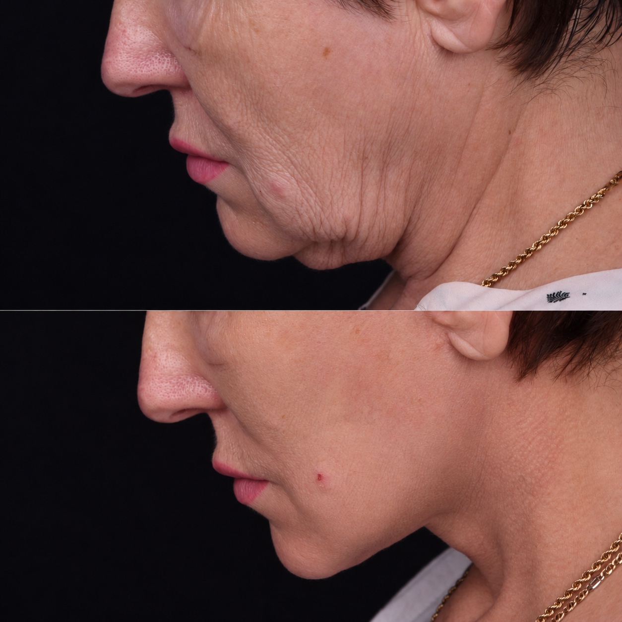Lifting du visage et du cou — Comparaison 4