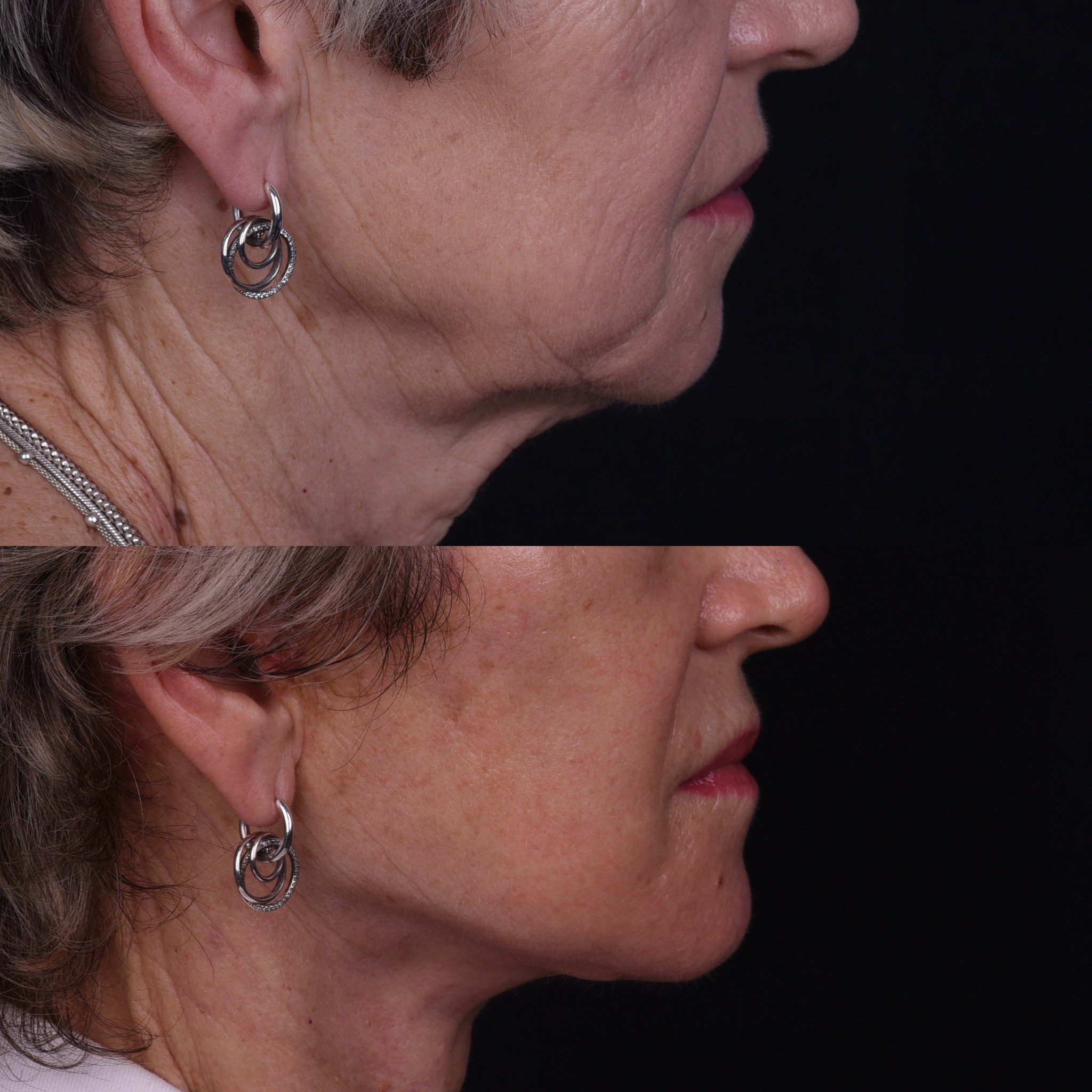 Lifting du visage et du cou — Comparaison 5