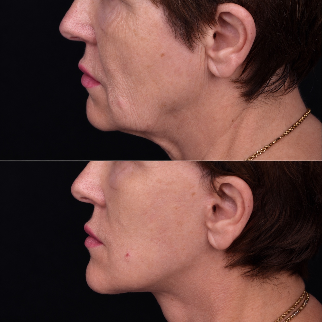 Lifting du visage et du cou — Comparaison 6
