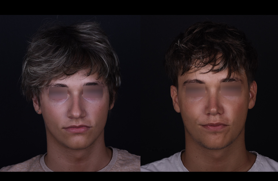 Comparaison avant-après de rhinoplastie, yeux masqués