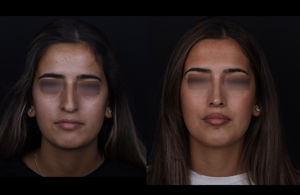Avant à gauche, après à droite — Face