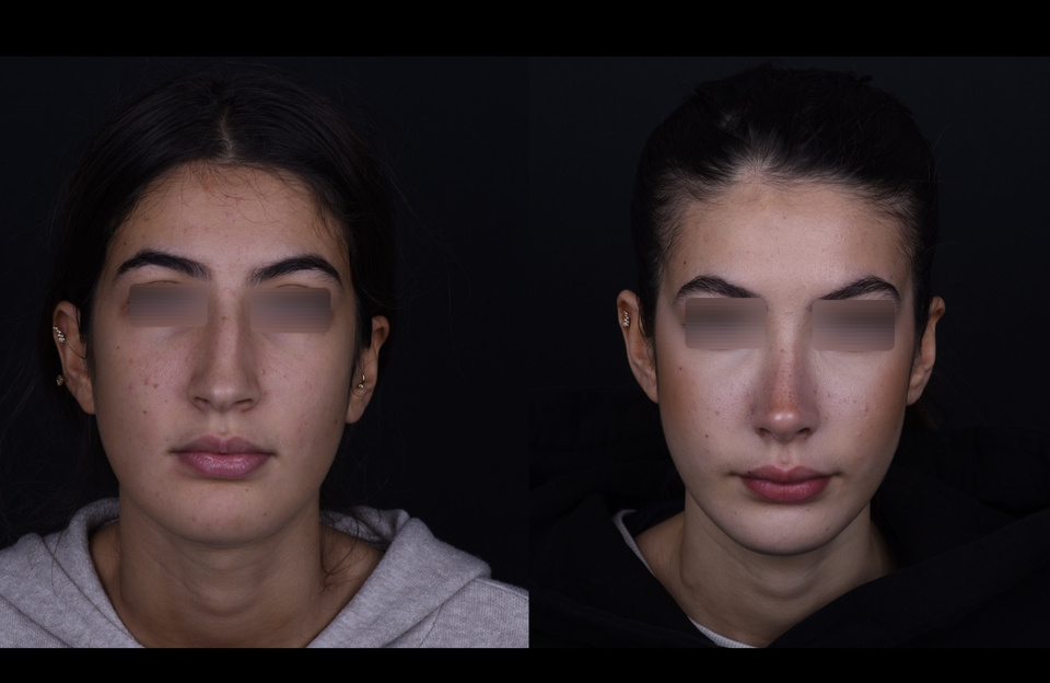 Avant à gauche, après à droite — Face